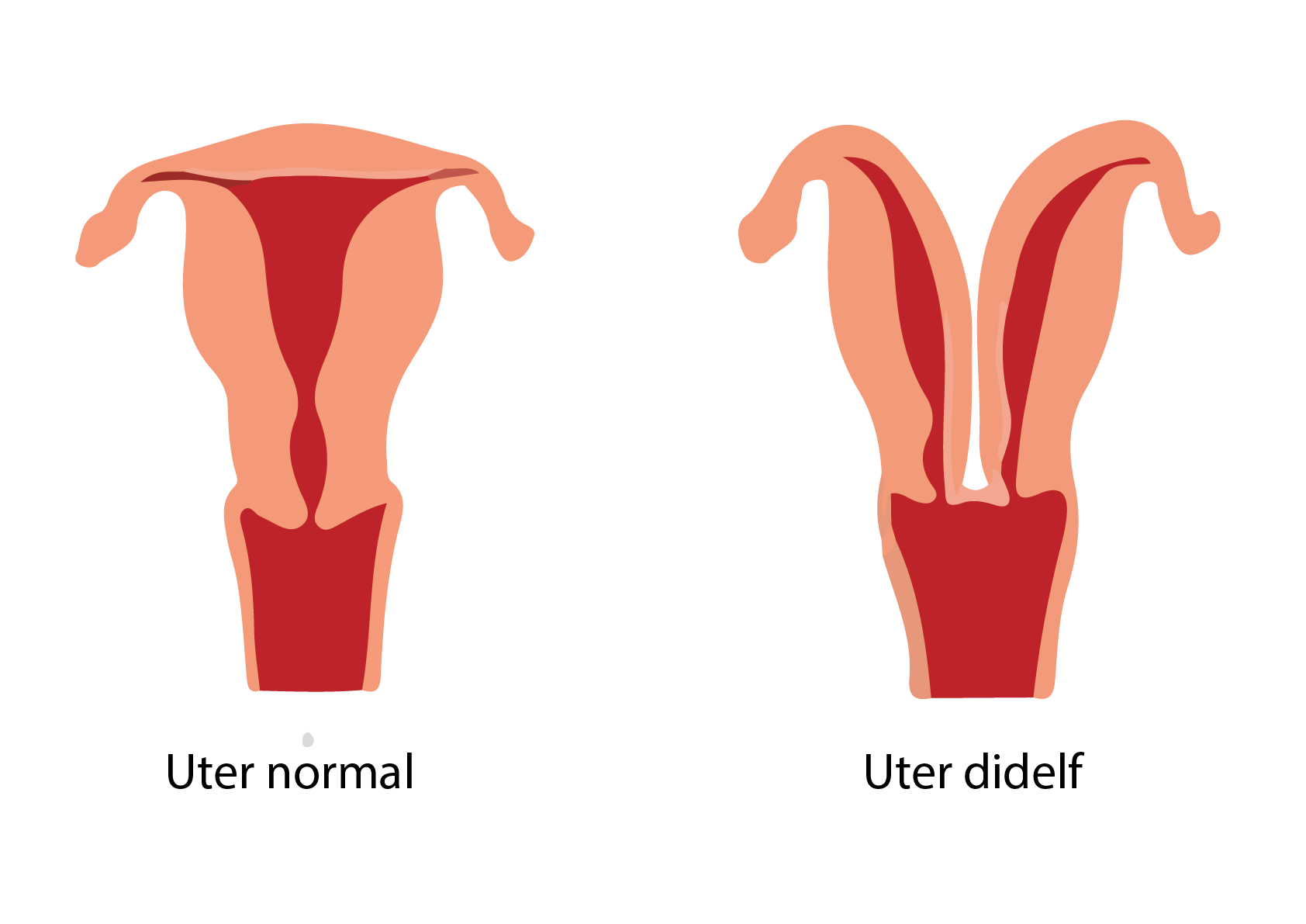 Uter normal vs uter didelf